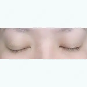 5 days after image