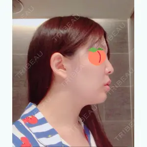0 days after image