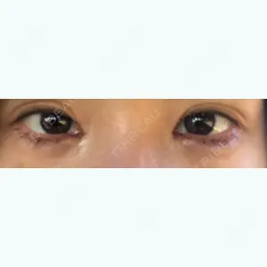 1 days after image
