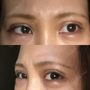 0 days after image
