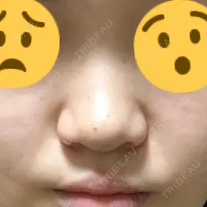 5 days after image