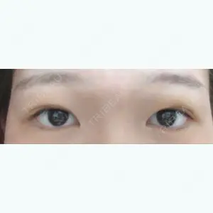 5 days after image