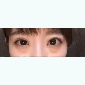 11 days after image