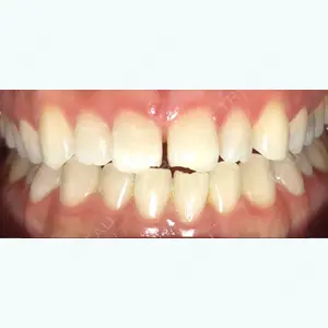 0 days after image