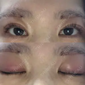 2 days after image