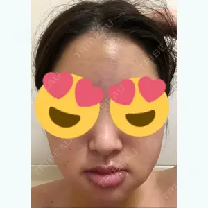 5 days after image