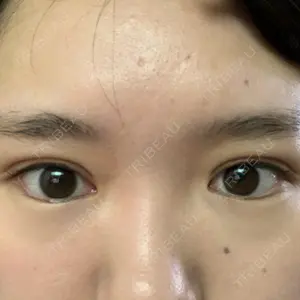 1 days after image