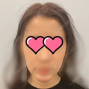 0 days after image