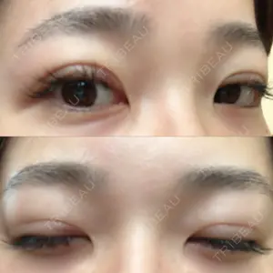 14 days after image