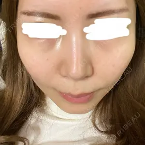 0 days after image