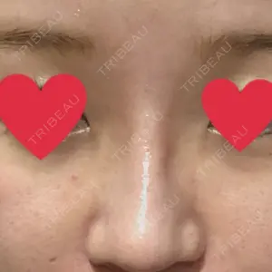 0 days after image