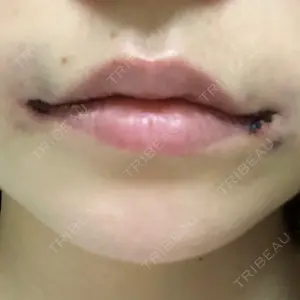 1 days after image