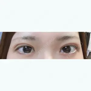 1 days after image