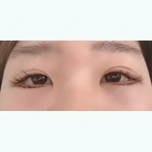 1 days after image