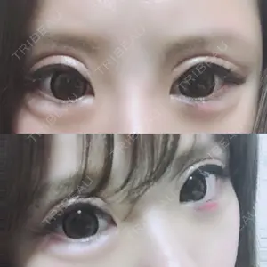 0 days after image