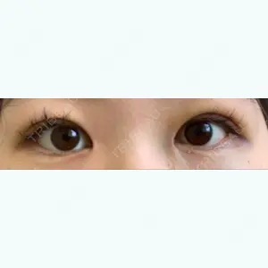 5 days after image