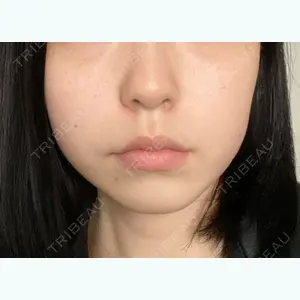 3 days after image