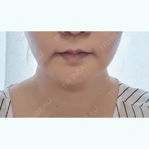 38 days after image