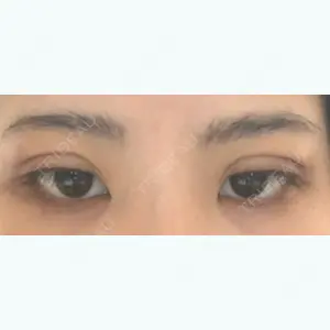 1 days after image