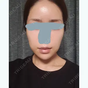44 days after image