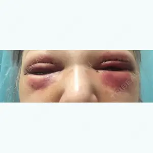 2 days after image