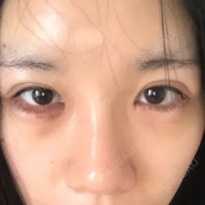 14 days after image