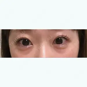 45 days after image