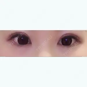 45 days after image