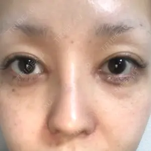 14 days after image