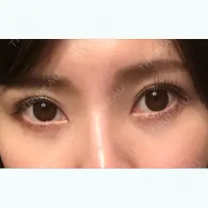 87 days after image