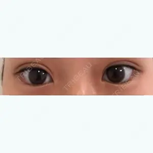 17 days after image