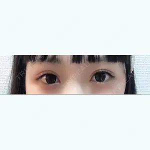 95 days after image
