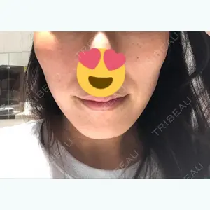 0 days after image