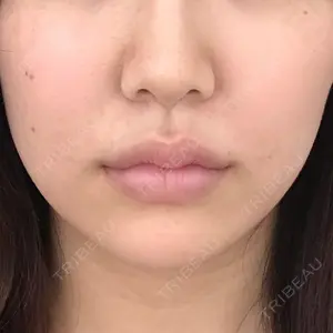 0 days after image