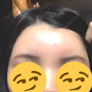 1 days after image