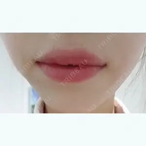 5 days after image