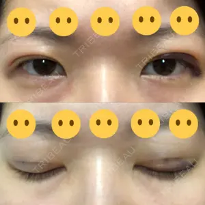 2 days after image