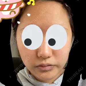 0 days after image