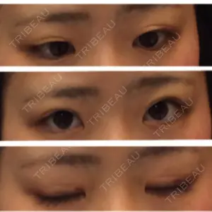 15 days after image