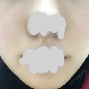 14 days after image