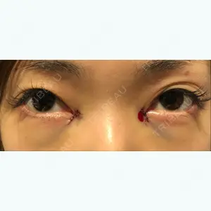 0 days after image