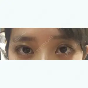 2 days after image
