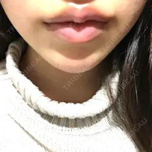 0 days after image
