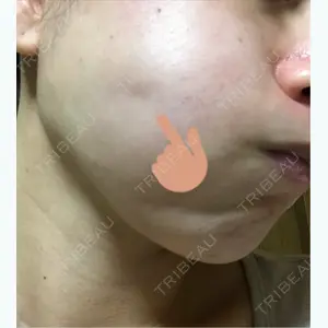 52 days after image