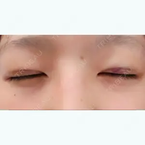 0 days after image