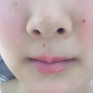 4 days after image