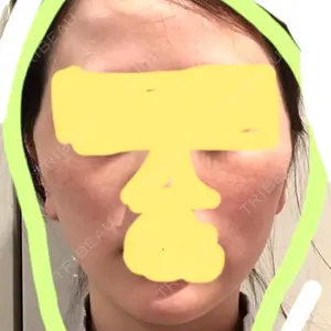1 days after image