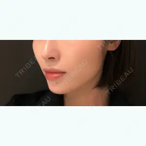 17 days after image