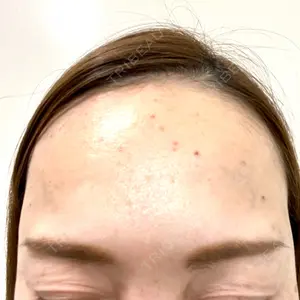 8 days after image