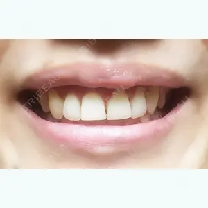 2 days after image